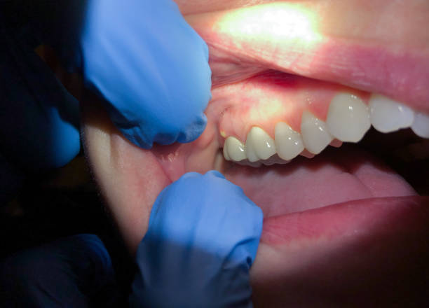 Best Urgent Care for Lost Fillings or Crowns in Colquitt, GA